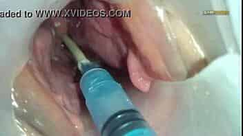 Sperm injected into the uterus of the wife of others video